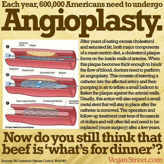 Each year, 600,000 Americans need to undergo angioplasty.